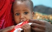 Baby Kali (18 months old) in Filtu Regional Hospital, Somali Region, Ethiopia. Kali is being treated for severe acute malnutrition with the support of International NGO Concern Worldwide. Photo: Jennifer Nolan/ Concern Worldwide