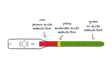 A mid-upper arm circumference tape, also known as a MUAC band