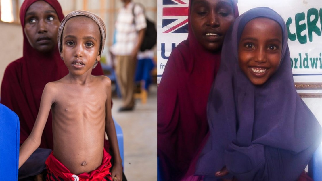 Yasmiin before treatment and after The best kind of “before and after.” When Yasmiin arrived at our clinic, she was severely malnourished. After nine weeks of treatment, she was a happy, smiley kid again.