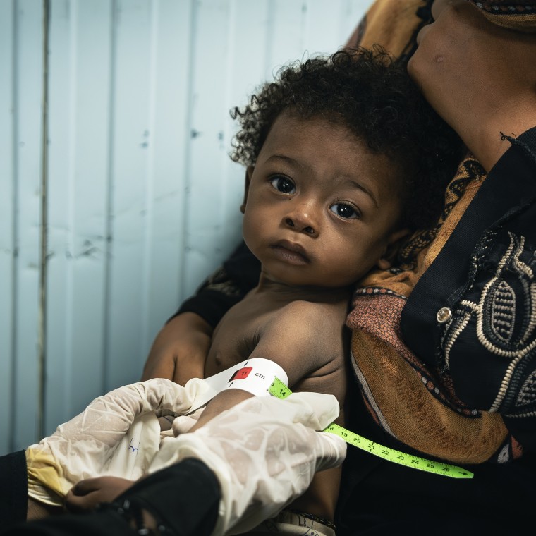 A young child who is acutely malnourished is seated in the lap of a health worker in Yemen. Another health worker is measuring the child’s upper arm to check whether he is gaining weight and how well he is progressing.